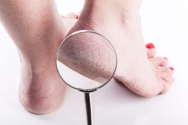 Zelf eelt verwijderen voeten; hoe ontstaat en voorkomen tot pleisters of zalf Eelt kan heel vervelend zijn. Het kan behoorlijk zeer doen en het ziet er ook niet echt mooi uit als je een dagje naar de wellness gaat of op je mooie slippers rond wil lopen. Wat is nu eigenlijk eelt? Waarom ontstaat dit? En vooral: wat kun je eraan doen? Gelukkig zijn er meerdere manieren om de pijn te voorkomen en het eelt te verwijderen!