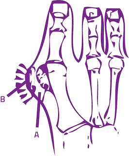 Hallux Abducto Valgus Slijmbeurs Grote Teen Podotherapie Reggestreek Rijssen