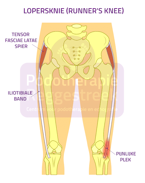 Adelaide Hesje Vader fage Lopersknie (Runner's Knee) | Podotherapie Reggestreek