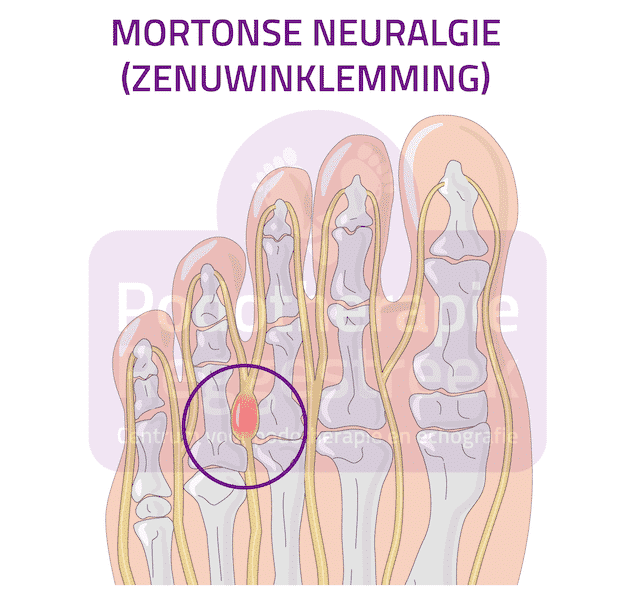 Kust Buitenlander Analytisch Mortonse Neuralgie | Podotherapie Reggestreek