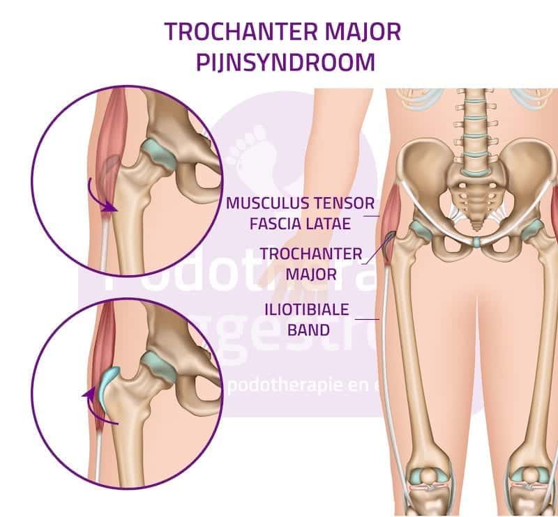 munitie Afleiden Inactief Pijn buitenkant heup | Podotherapie Reggestreek - Een stap vooruit!