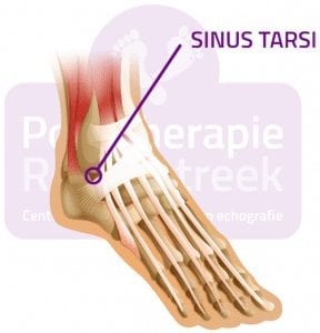 Sinus Tarsi Syndroom Podotherapie Reggestreek Rijssen