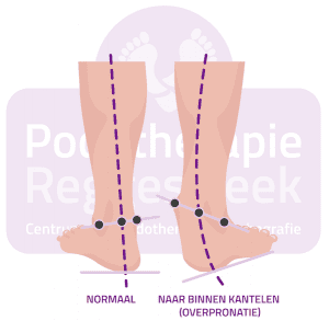 Stand van de voet pronatie normaal Hypermobiliteit Podotherapie Reggestreek Rijssen.png