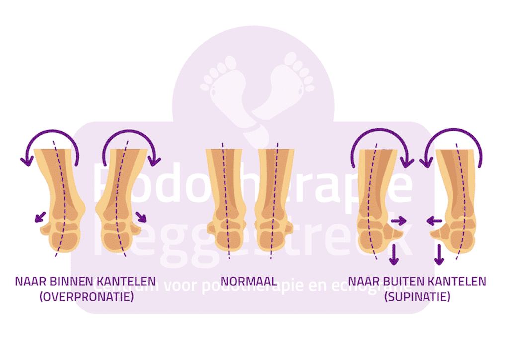 Stand Voet Normaal Valgisatie Varisatie Achillespeesklachten Achillespeesblessure Podotherapie Reggestreek Rijssen