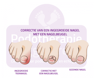 Nagelbeugel Ingegroeide Teennagel Podotherapie Reggestreek Rijssen