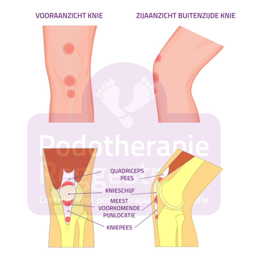 Springersknie Jumpers Knee Podotherapie Reggestreek Rijssen