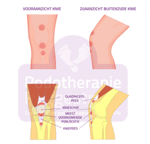 Springersknie Jumpers Knee Podotherapie Reggestreek Rijssen Springersknie Jumpers Knee Podotherapie Reggestreek Rijssen