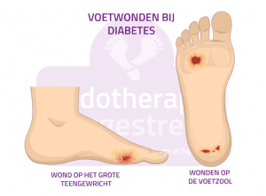 Voetwonden bij diabetes Wonbehandeling Podotherapie Reggestreek Rijssen