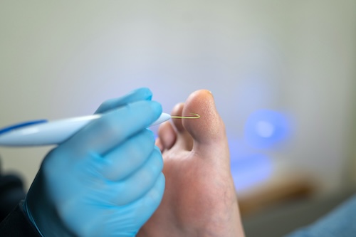 Podotherapie Reggestreek Monofilament
