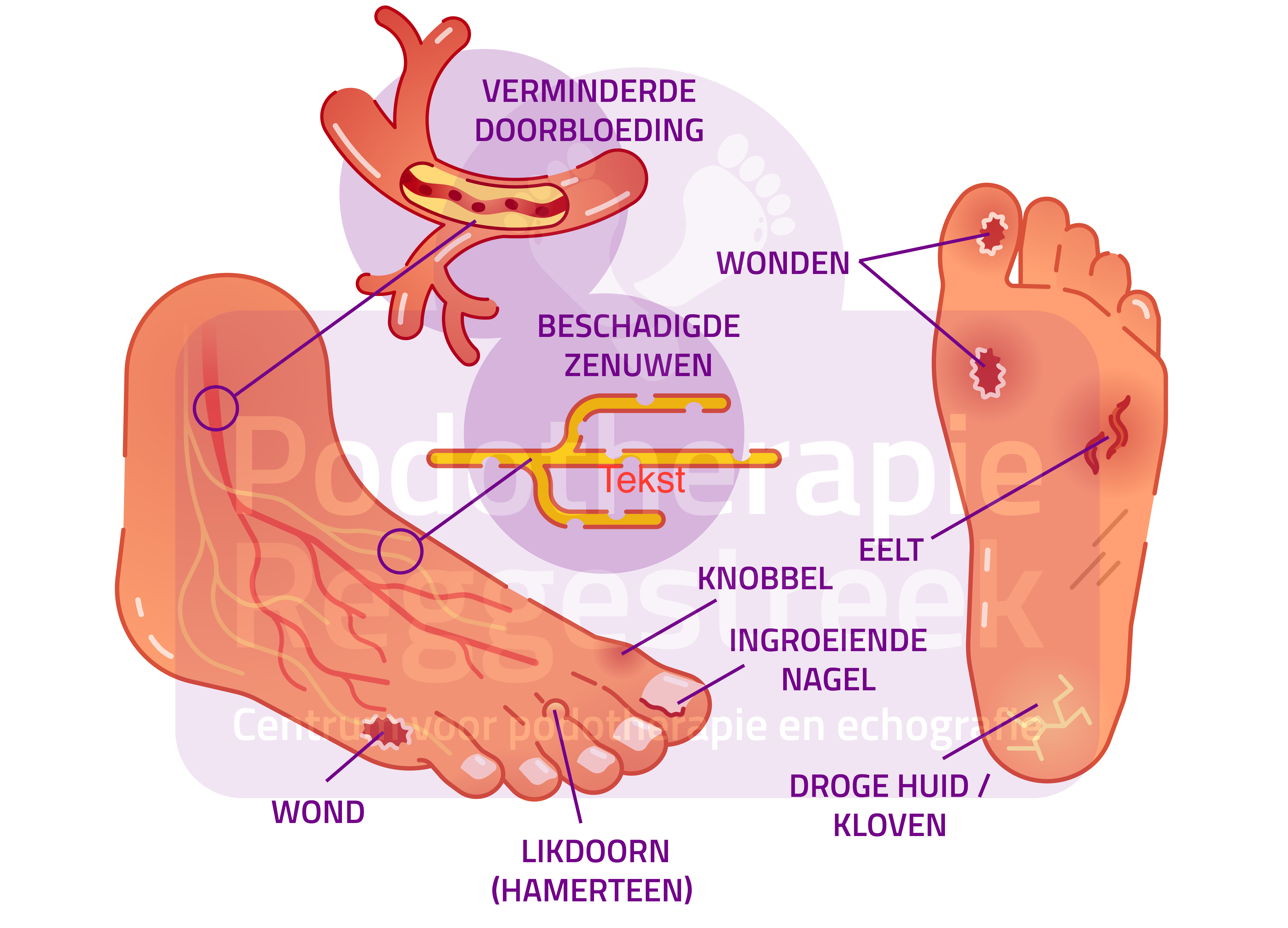 zorgmodule-preventie-voetulcera