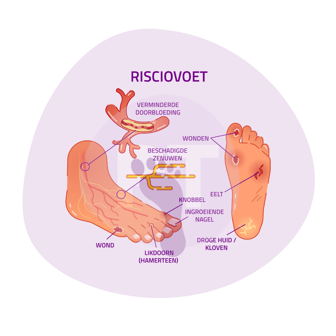 Risicovoet Zorgmodule Preventie Voetulcera 2024 Podotherapie Reggestreek